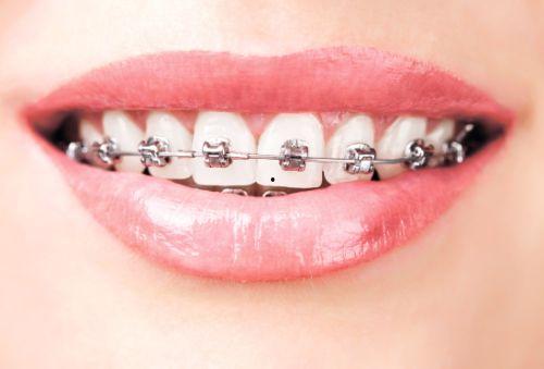 国产牙套效果怎样样啊视频,揭秘国产矫正器的真实表现