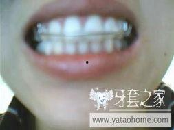 国产牙套效果怎样样啊视频,揭秘国产矫正器的真实表现