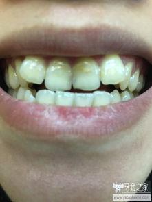 国产牙套效果怎样样啊视频,揭秘国产矫正器的真实表现