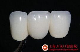 国产全瓷牙冠唯美视频,见证口腔美学新篇章